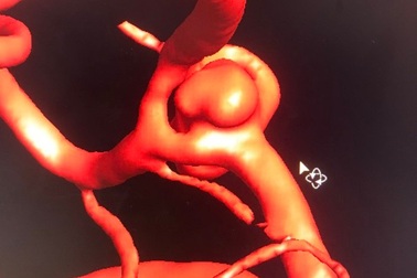 Bệnh nhân đột quỵ 2 túi phình mạch máu não được cứu sống bằng kỹ thuật mới