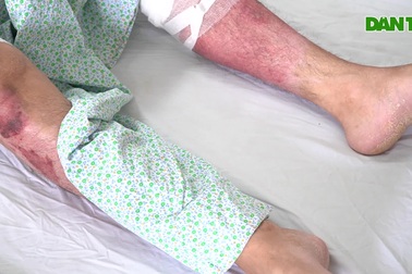 Người đàn ông bỏng nặng khi dùng cồn nướng mực vì sai lầm nhiều người mắc