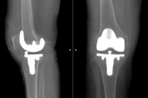 Tập đi sau 6 tiếng mổ thay khớp gối nhờ ứng dụng công nghệ 3D