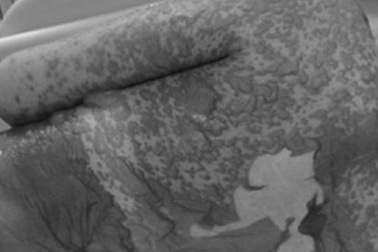 Nhiều người bỗng lở loét, tuột da vì hội chứng hiếm gặp nguy hiểm