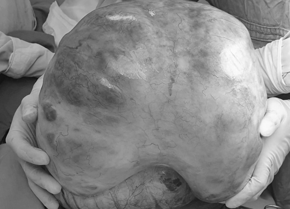 Ra sức tập luyện giảm cân, cô gái sốc với khối u 13kg - 1 Ra sức tập luyện giảm cân, cô gái sốc với khối u 13kg - 1