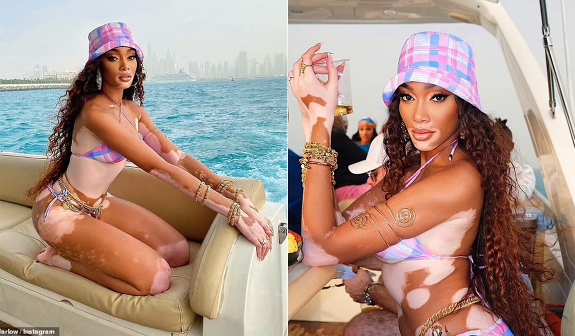 Siêu mẫu bạch biến Winnie Harlow khoe chân thon trong kỳ nghỉ tại Dubai - 2 Siêu mẫu bạch biến Winnie Harlow khoe chân thon trong kỳ nghỉ tại Dubai - 2