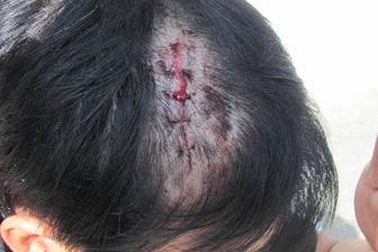 Côn đồ xông vào bến xe chém trọng thương bảo vệ