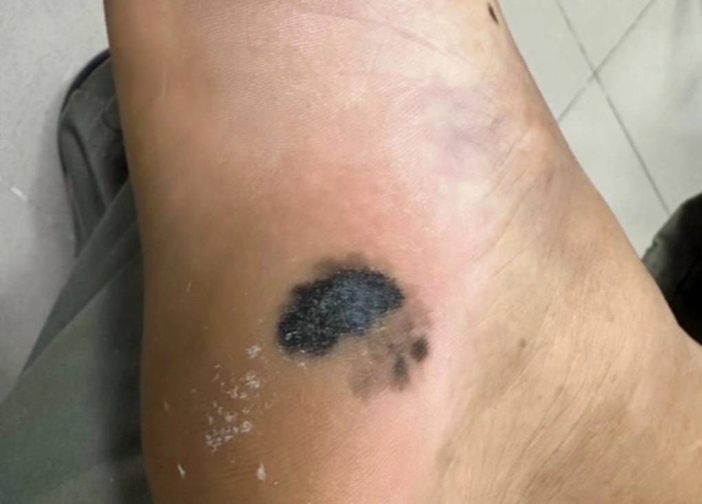 Mang vết đen lạ ở gót chân 10 năm, người phụ nữ bất ngờ khi bị ung thư - 2 Mang vết đen lạ ở gót chân 10 năm, người phụ nữ bất ngờ khi bị ung thư - 2