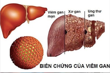 Viêm gan B lây lan nhanh hơn HIV gấp 100 lần, dùng chung bát đũa có lây?