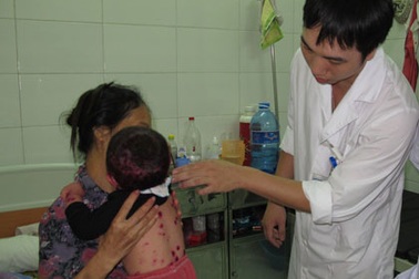 Biến chứng của thủy đậu có thể gây tử vong