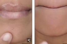 ​Video: Trị mụn đầu trắng bằng tỏi