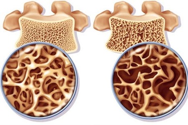 Cẩn thận khi tê mỏi tay chân