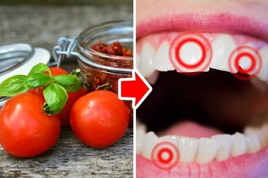 10 thực phẩm gây hại cho răng hàng đầu cần tránh