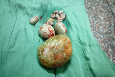 Cụ bà 84 tuổi mang trong người viên sỏi bàng quang to bằng quả trứng ngỗng