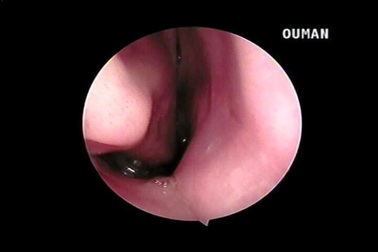 Kinh hoàng hai con vắt sống trong mũi bệnh nhân