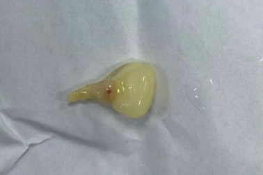 Người đàn ông suýt chết vì hạt ngô rơi vào đường thở