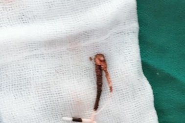 Đi khám tiểu dắt, nữ bệnh nhân ngỡ ngàng phát hiện vòng tránh thai trôi vào bàng quang