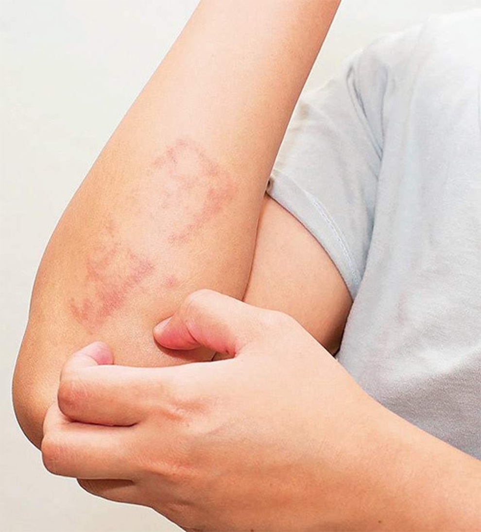 Bệnh vẩy nến làm tăng nguy cơ ung thư? - 1 Bệnh vẩy nến làm tăng nguy cơ ung thư? - 1