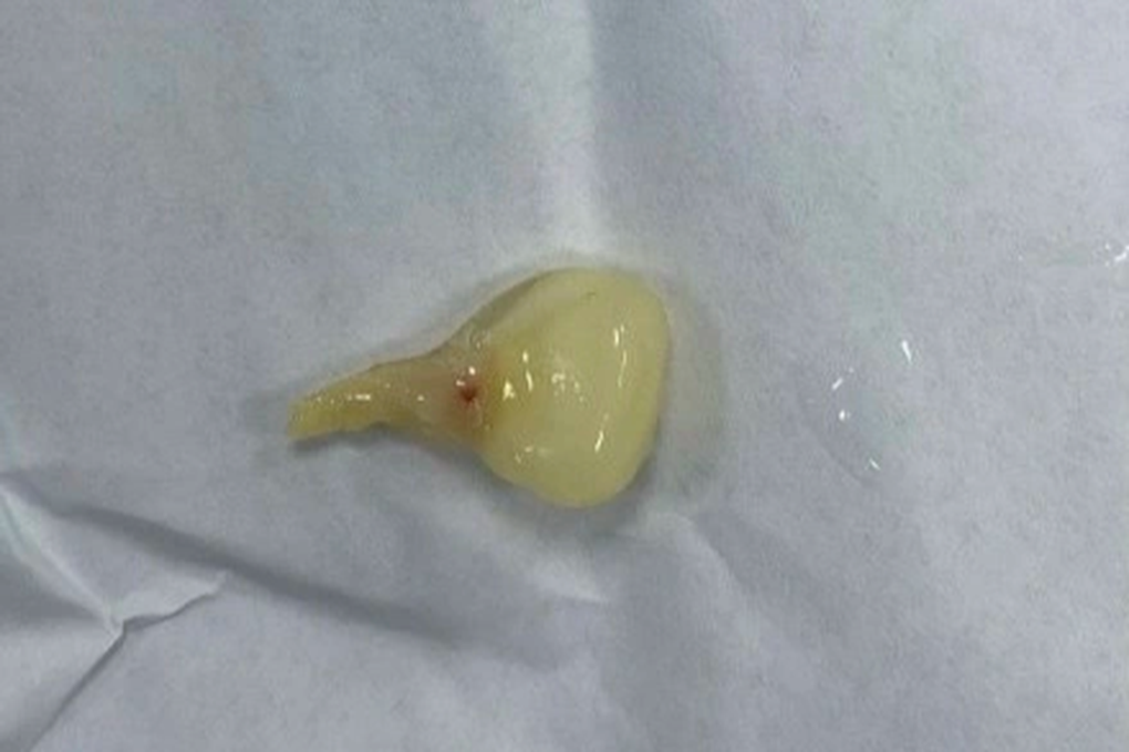 Người đàn ông suýt chết vì hạt ngô rơi vào đường thở - 1 Người đàn ông suýt chết vì hạt ngô rơi vào đường thở - 1