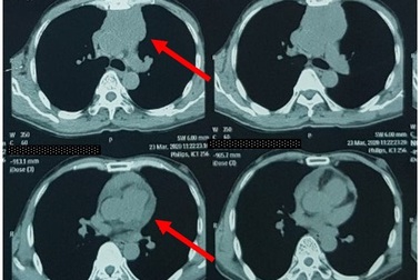 Ung thư tuyến ức - Bệnh lý ung thư hiếm gặp