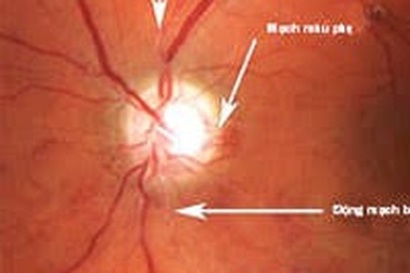 Cảnh giác mờ “cửa sổ” vì đái tháo đường
