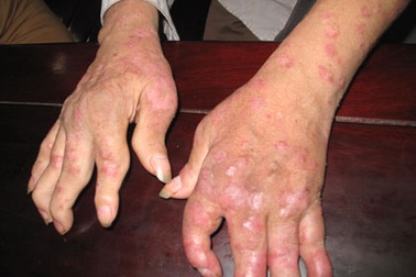 Người bệnh vẩy nến khốn khổ với “nốt hoa râm”, bong tróc toàn thân