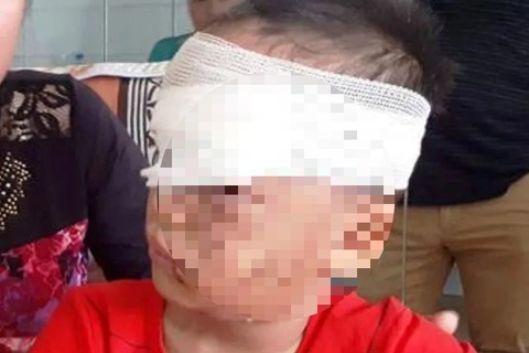 Bé trai 12 tuổi bị chó tấn công vào đầu, tai chấn thương nặng
