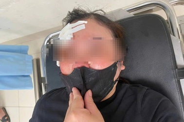 Người phụ nữ ở Hà Nội tố cáo bị tài xế xe bán tải vụt dùi cui vào đầu