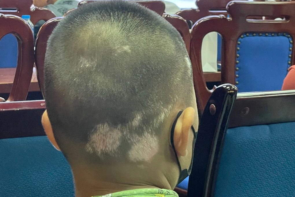 Bệnh bạch biến: Những đốm trắng loang lổ có thể trở về màu da bình thường - 1 Bệnh bạch biến: Những đốm trắng loang lổ có thể trở về màu da bình thường - 1
