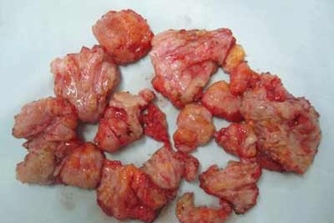 Nam nhi suýt chết vì bơm ngực, độn mông 