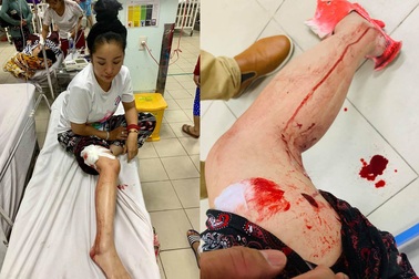 Danh hài Thúy Nga gặp tai nạn phải khâu gần 10 mũi