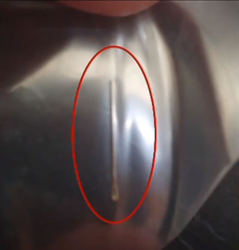 Cô bé 14 tuổi nhập viện vì nuốt phải kim trong táo mua siêu thị - 2 Cô bé 14 tuổi nhập viện vì nuốt phải kim trong táo mua siêu thị - 2