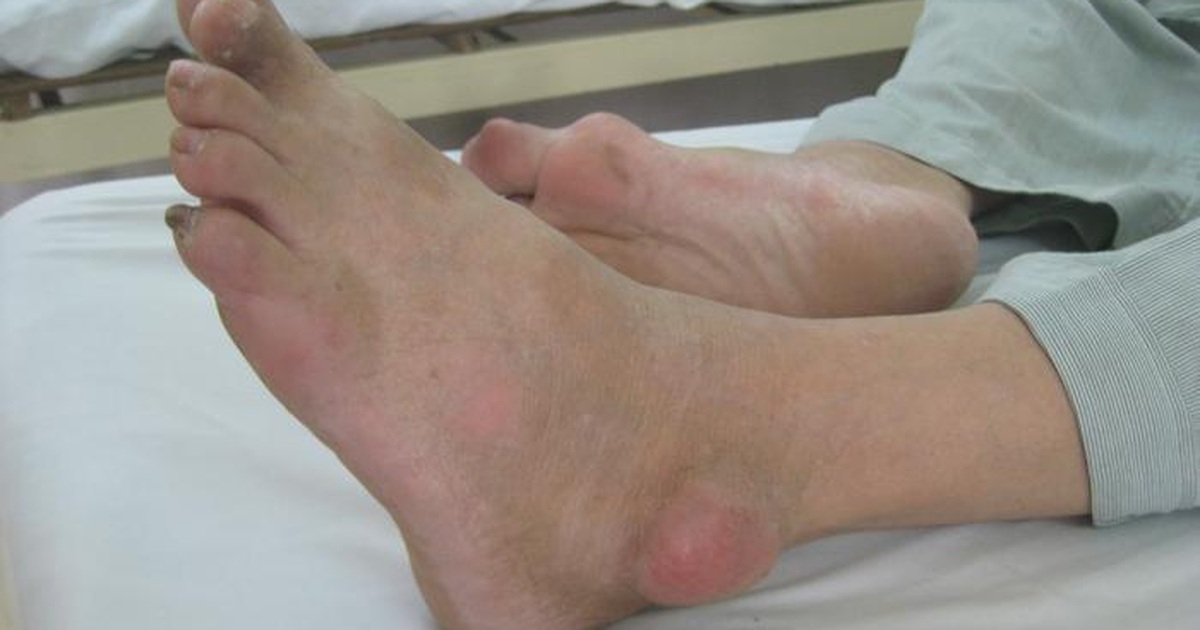 1. Tổng quan về bệnh gout và triệu chứng ở mắt cá chân