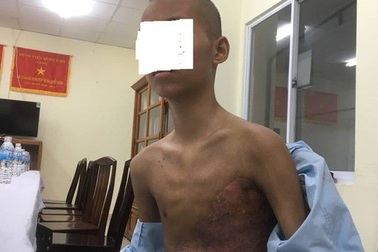 Bị xe buýt tông, 1 bé trai dập phổi và gãy 5 xương sườn