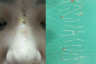 Mũi nữ diễn viên thủng nhiều lỗ sau 2 tháng cấy chỉ nâng mũi