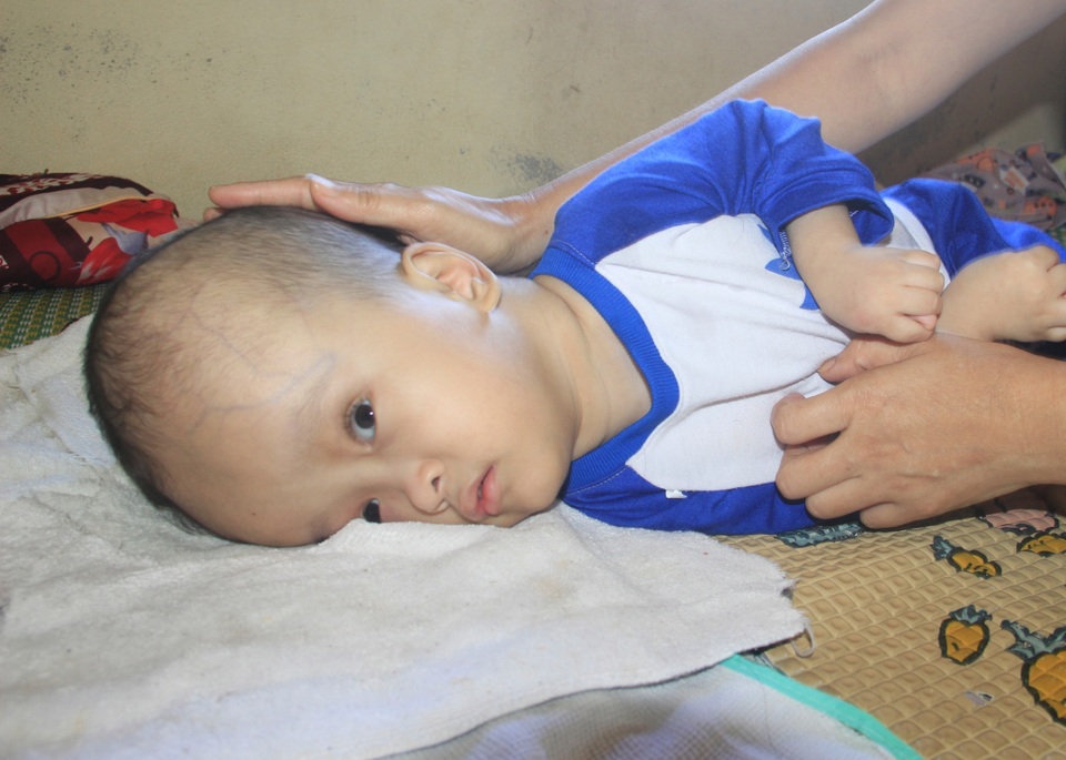 Xót xa cảnh vợ mù lòa ôm con bị não úng thủy nằm liệt giường suốt nhiều năm - 3 Xót xa cảnh vợ mù lòa ôm con bị não úng thủy nằm liệt giường suốt nhiều năm - 3