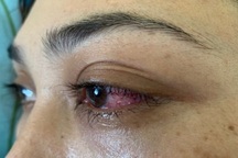 Tưởng đau mắt đỏ, bệnh nhân suýt mù vì bệnh lý hiếm gặp