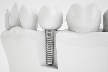 Cấy răng Implant - “Cứu tinh” cho nỗi khổ mất răng