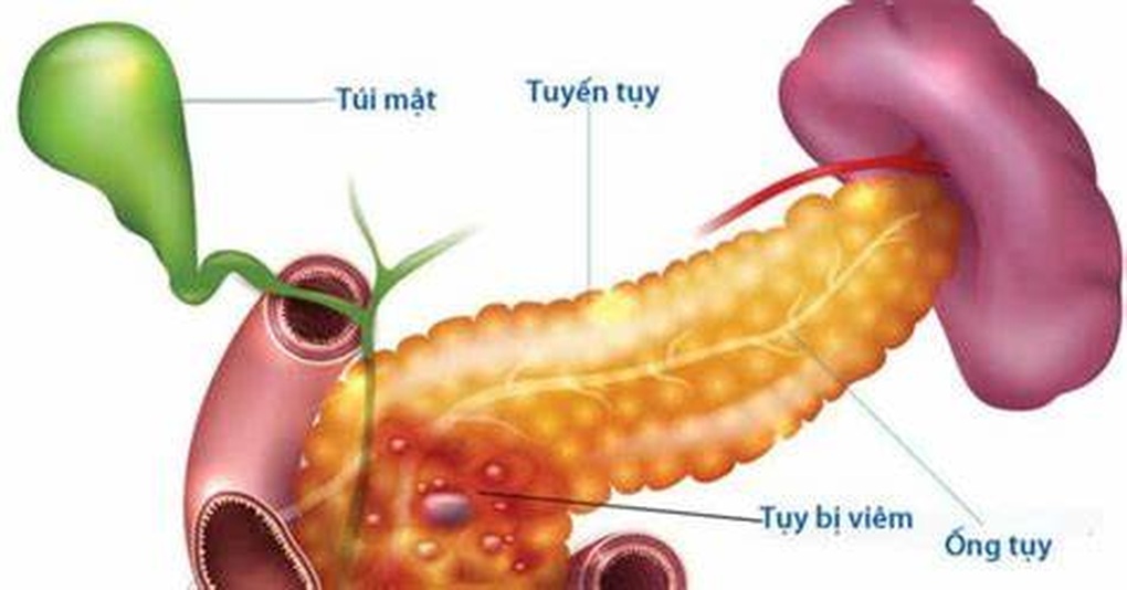 Điều bạn nhất định phải biết khi ăn để bảo vệ tuyến tụy - 1