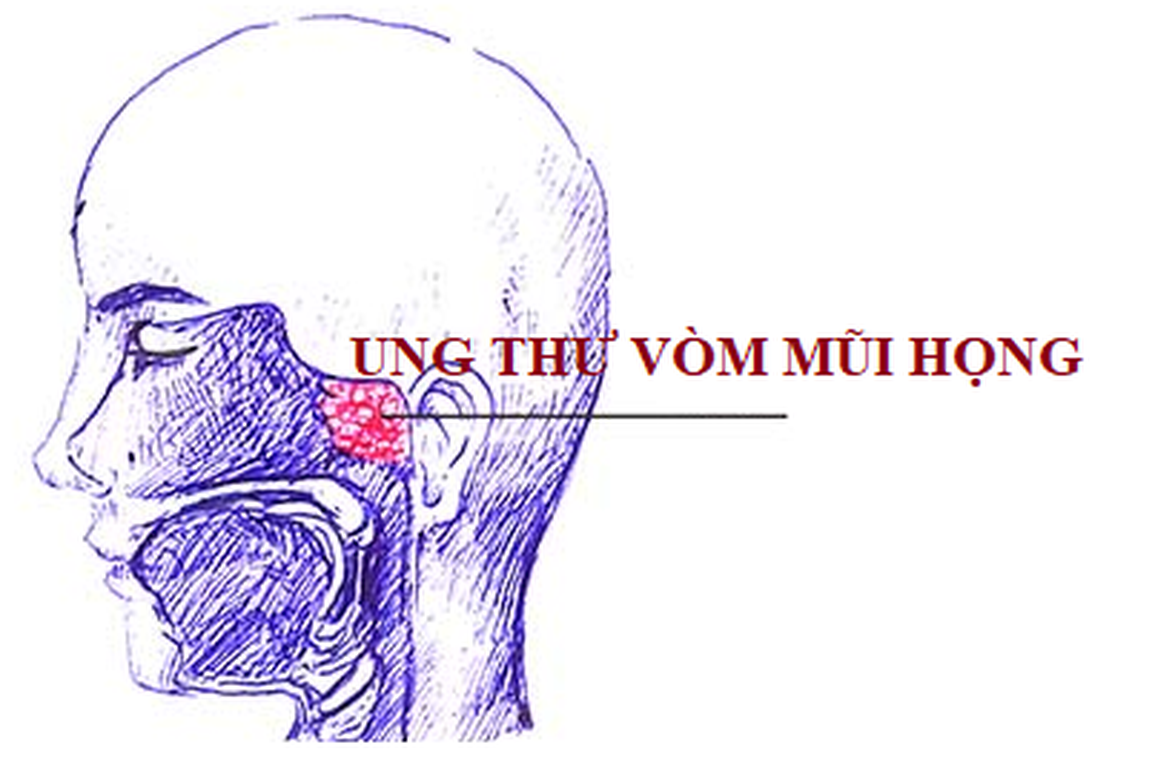 Dấu hiệu sớm ung thư vòm mũi họng - 1 Dấu hiệu sớm ung thư vòm mũi họng - 1