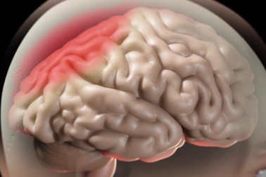 Phù não khi điều trị u