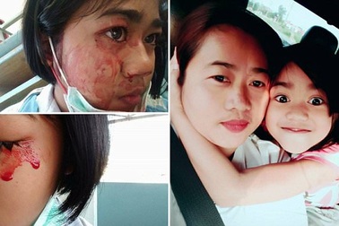 Cô bé 7 tuổi khóc, đồ mồ hôi máu mỗi khi đau đầu