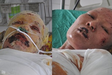 Nổ bình ga, tính mạng 2 vợ chồng người dân tộc Dao nguy kịch