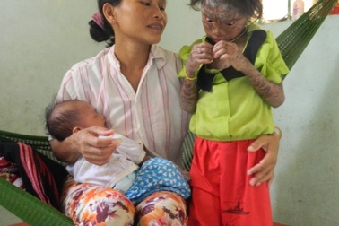 Bé 9 tuổi bị bệnh vảy cá hiếm gặp