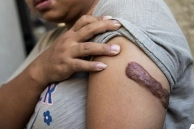 Ký ức ám ảnh của nữ giúp việc Indonesia bị chủ bạo hành suốt 2 năm trời