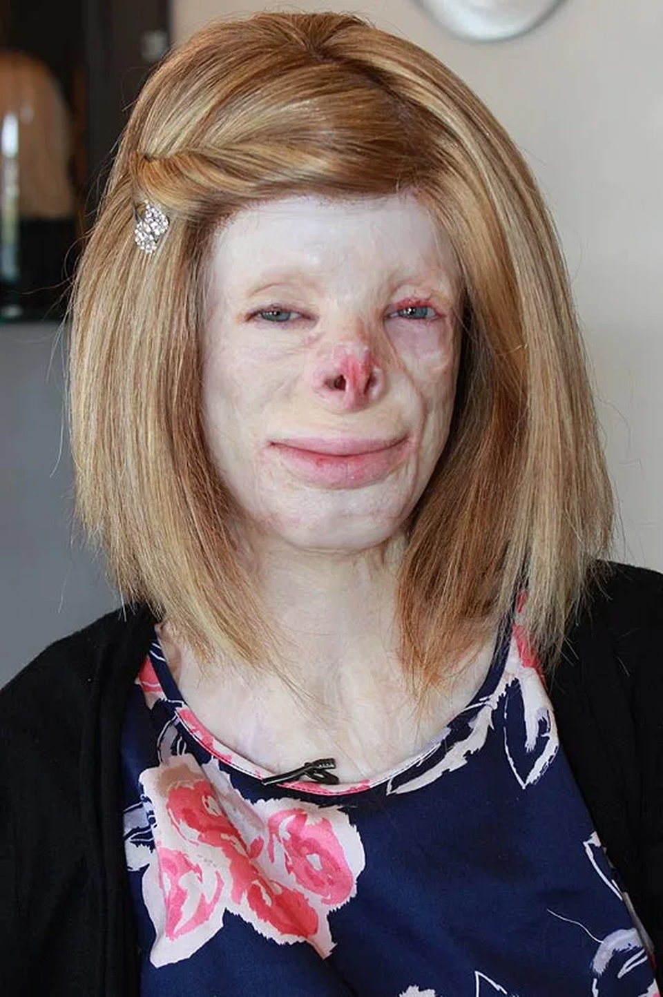 Hạnh phúc bất ngờ của cô gái từng bị bỏng đến biến dạng - 8