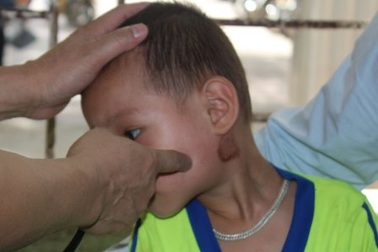 Xuất hiện chùm ca bệnh quai bị trong trường học