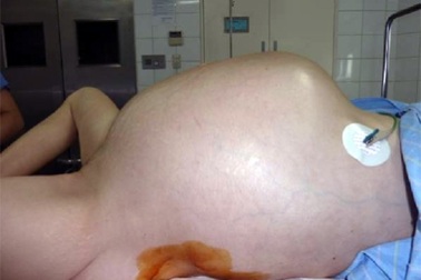 Cắt bỏ thành công khối u nặng 15 kg  