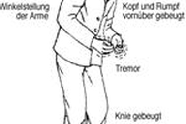 Sữa làm tăng nguy cơ bị Parkinson ở nam giới