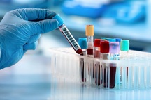 Có thể phát hiện sớm ung thư gan bằng xét nghiệm máu?