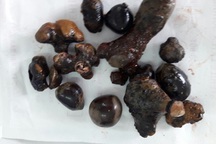 Người đàn ông bị sỏi san hô chằng chịt ở niệu quản