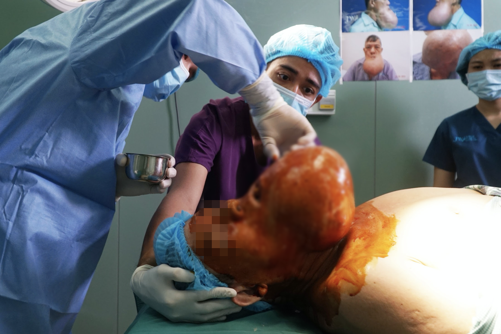 Người đàn ông nguy kịch vì khối u to bằng đầu sắp nổ tung dưới miệng - 2 Người đàn ông nguy kịch vì khối u to bằng đầu sắp nổ tung dưới miệng - 2