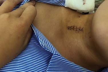 Thiếu nữ 17 tuổi vô tình bị đạn súng hơi bắn trúng cổ