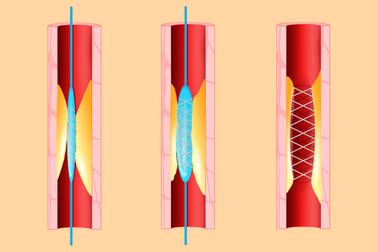 Stent tim: Đặt hay không đặt?